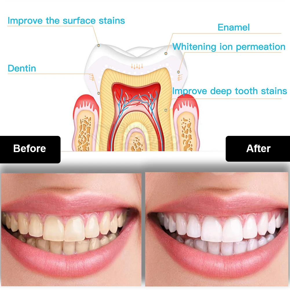 Dental Teeth Whitening Kit Min - огляд і ціна Teeth Whitening Flash