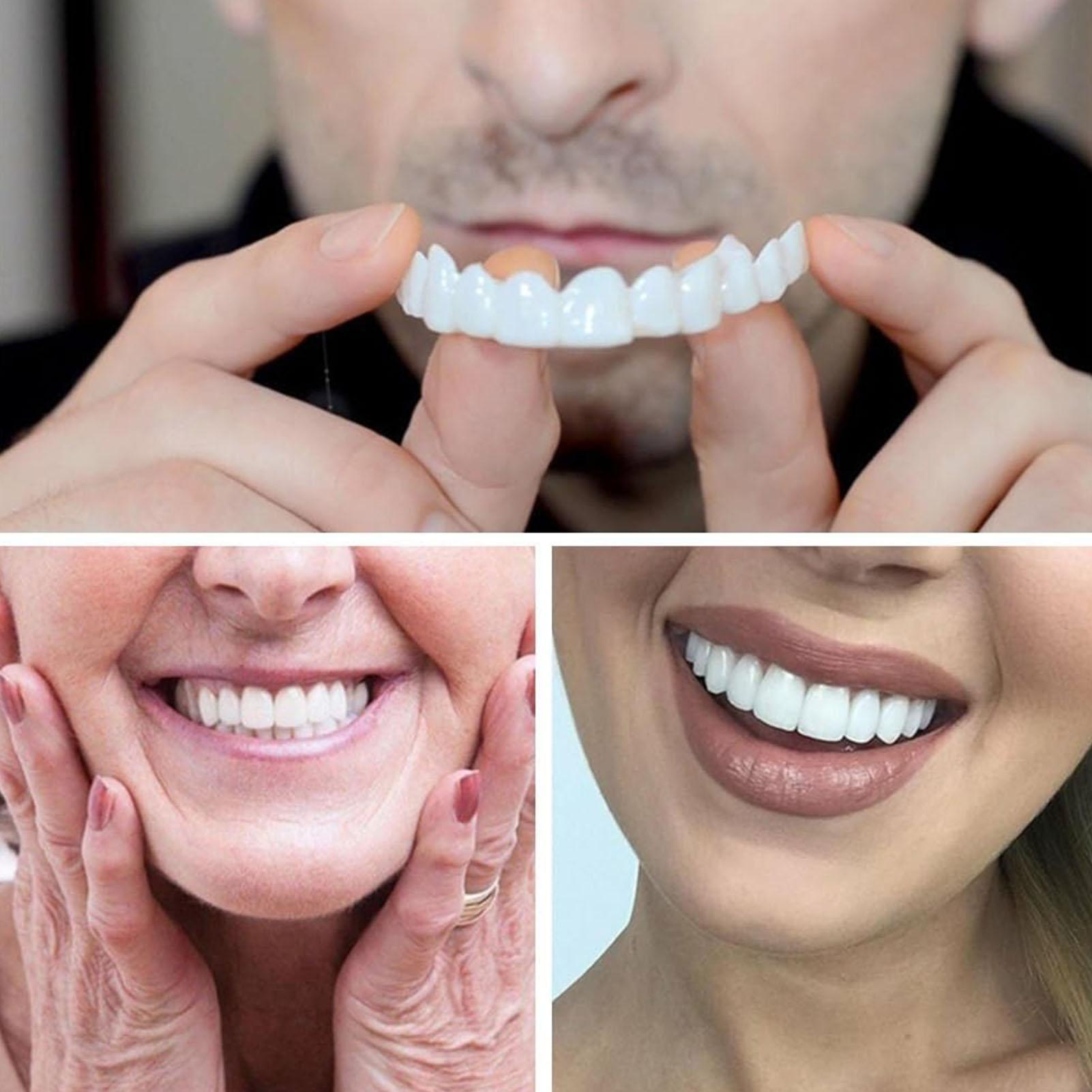 New Defect Repair Teeth Veneer - огляд і ціна Teeth Whitening Uneven