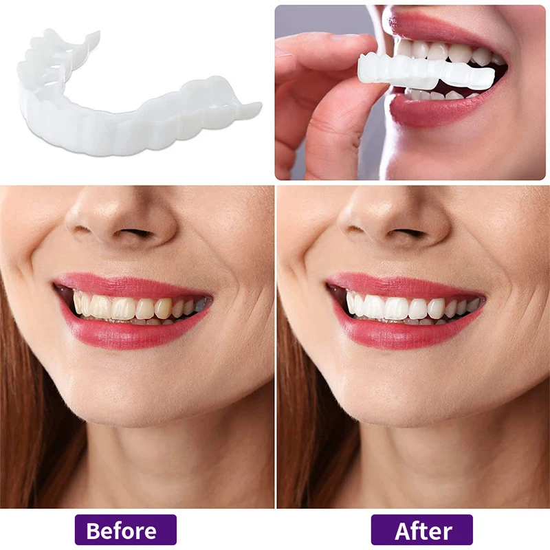 Defect Repair Teeth Veneers, T - огляд і ціна Teeth Whitening Uneven